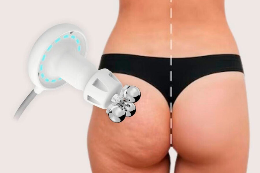 Remodelación corporal: reduce celulitis, tonifica músculos y mejora la firmeza con Zionic