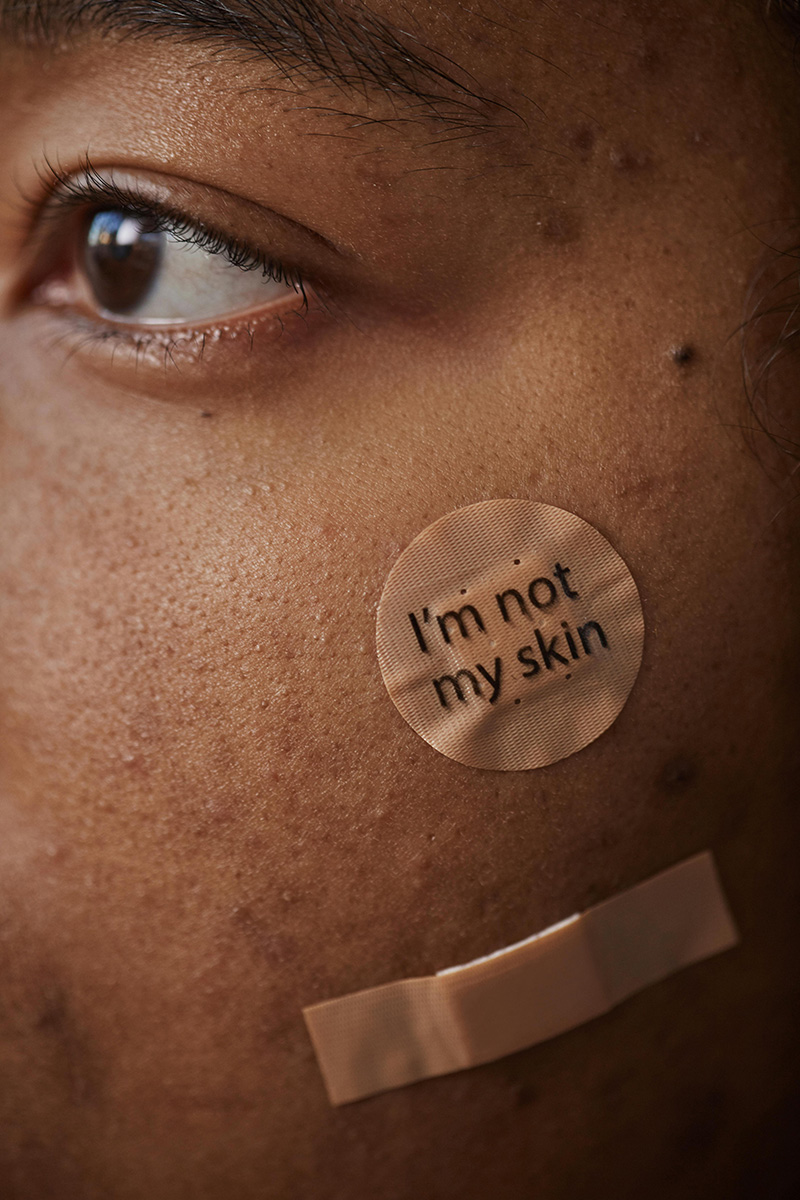 acne hormonal depresion