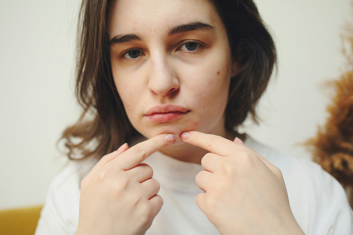 ¿Tienes acné hormonal? Así puedes identificarlo y tratarlo ¿Tienes acné hormonal? Así puedes identificarlo y tratarlo