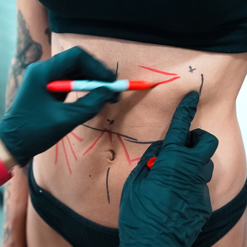 tratamiento endolyse