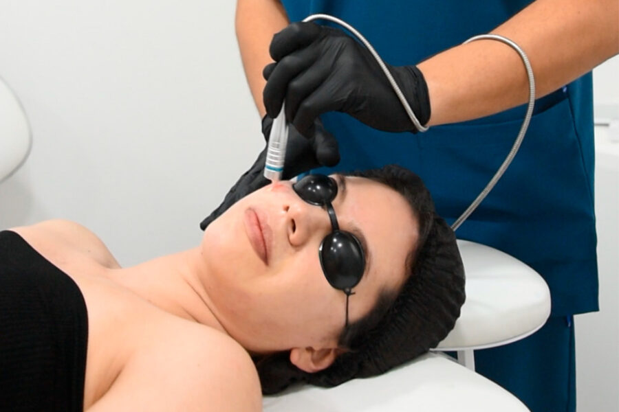 Resurfacing con Endolyse, el tratamiento tendencia del 2026 para una piel renovada de adentro hacia fuera